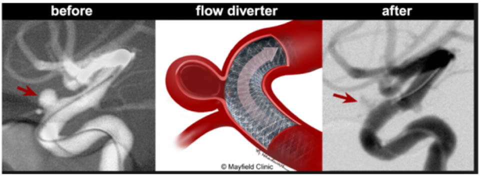 Endovascular intervention for Cerebral Aneurysm