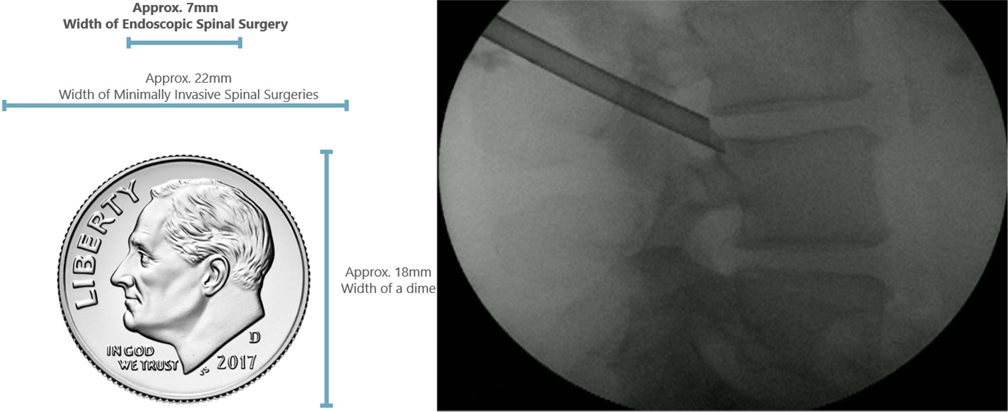 Endoscopic spinal surgery